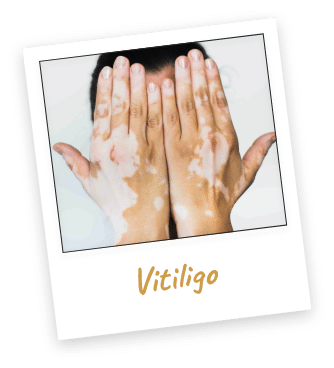 vitiligo sur main